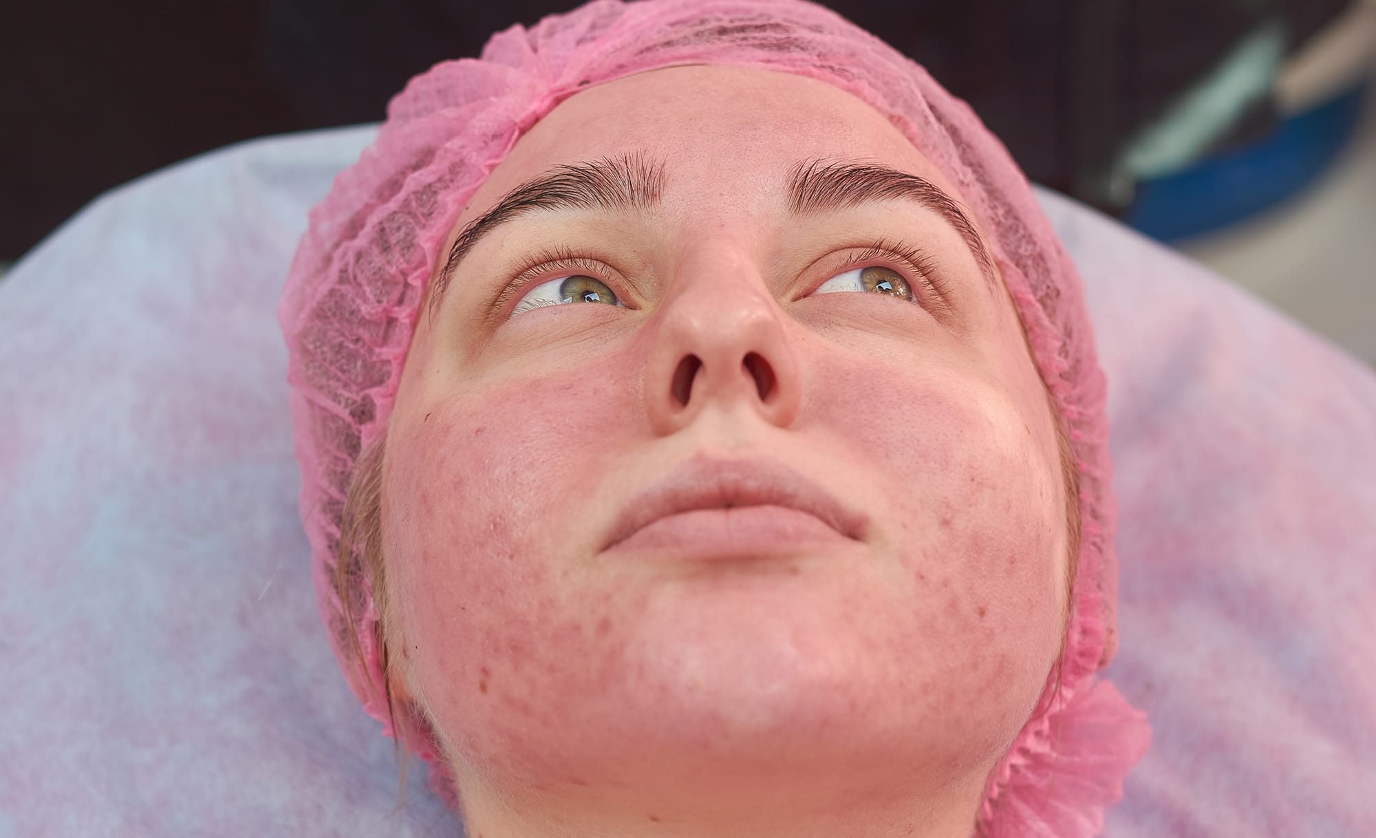 What Light Therapy Is Best for Rosacea?