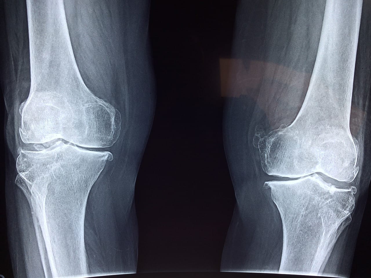 Red Light Therapy For Knee: Devices And Practical Tips