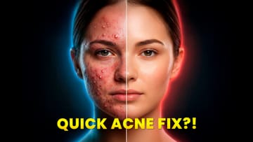 Best Device For Acne: Why You Need Blue Light